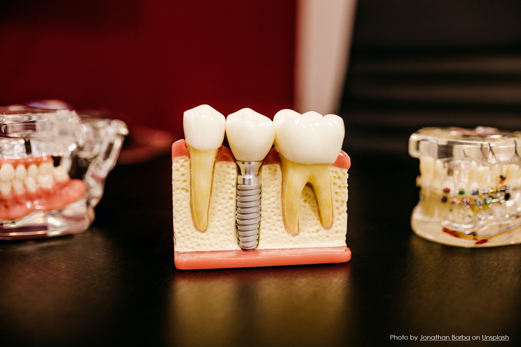 Τι είναι τα οδοντικά εμφυτεύματα;